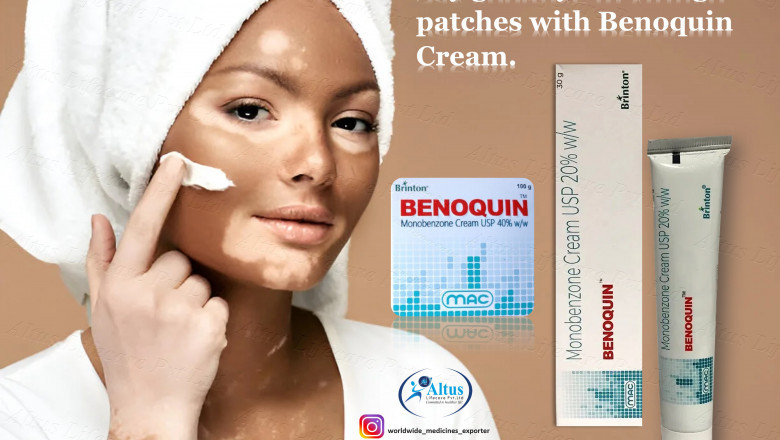 Benoquin 20% Cream A Breakthrough for Vitiligo Treatment!