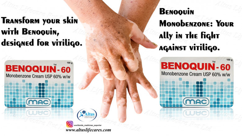 Benoquin 60% Cream for Vitiligo Is Going Viral – the Ultimate Solution?