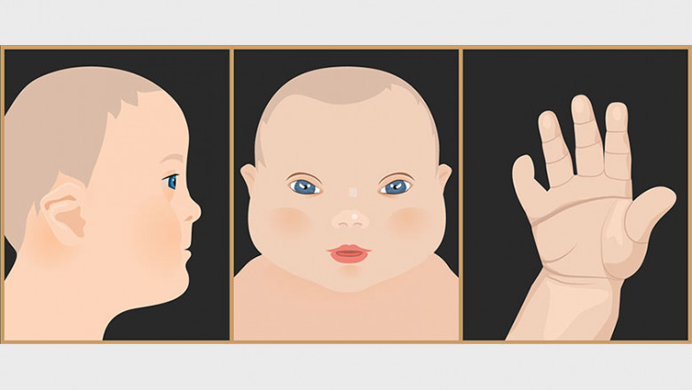 Down Syndrome Market Estimated to Witness High Growth Owing to Biomarker-Based Diagnostics