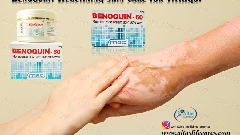 Thousands Are Using This Cream for Vitiligo – Is Benoquin 60% Cream the Answer?