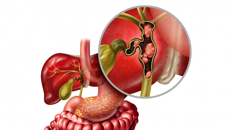 Biliary Tumor Market Set to Soar on Advances in Targeted Therapies