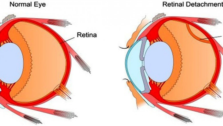 Comparing Retinal Detachment Surgery Options in Dubai