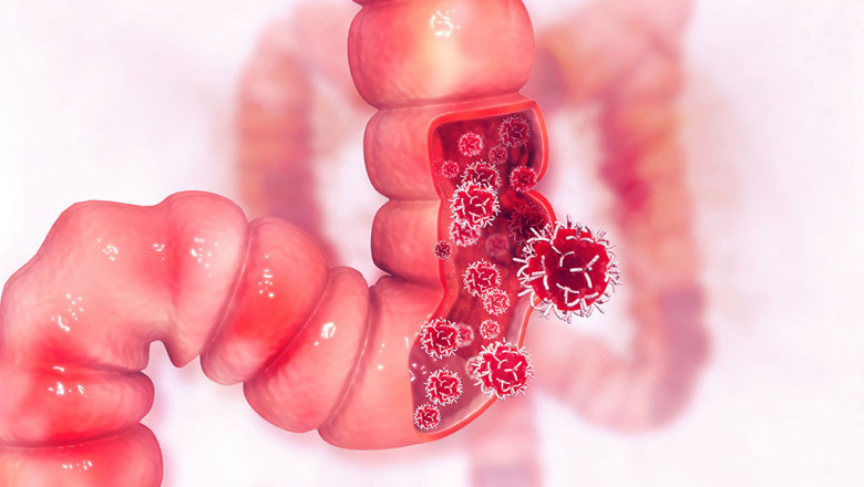 Metastatic Colorectal Cancer Market to Surge Owing to Innovative Therapies