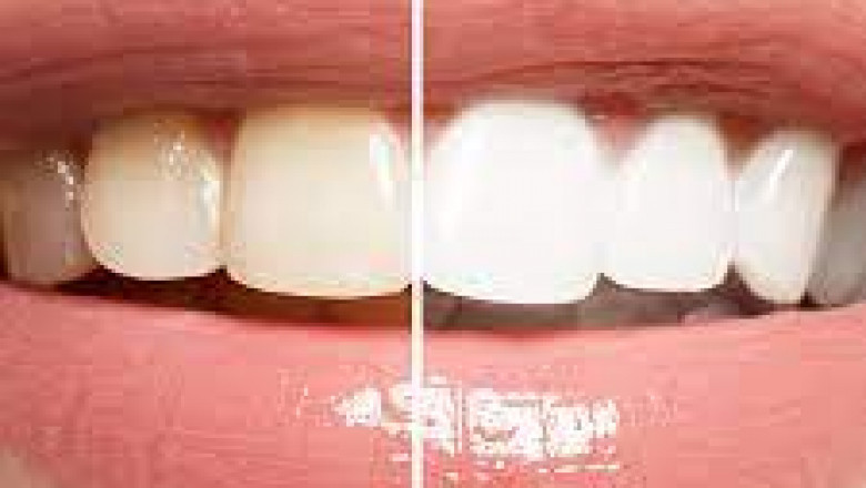 Dentist-Endorsed Gel Provides Gentle Gum Relief