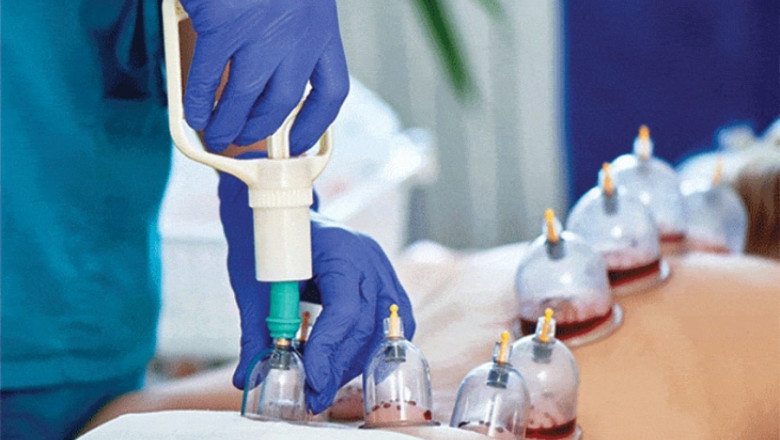 The Perfect Therapy for Health-Conscious Residents: Hijama Cupping