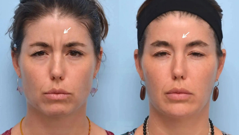 Best Aesthetic Clinics in Dubai Offering Botox for First-Time Clients