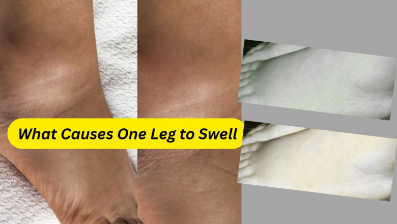 What Causes One Leg to Swell: Understanding the Causes and Concerns
