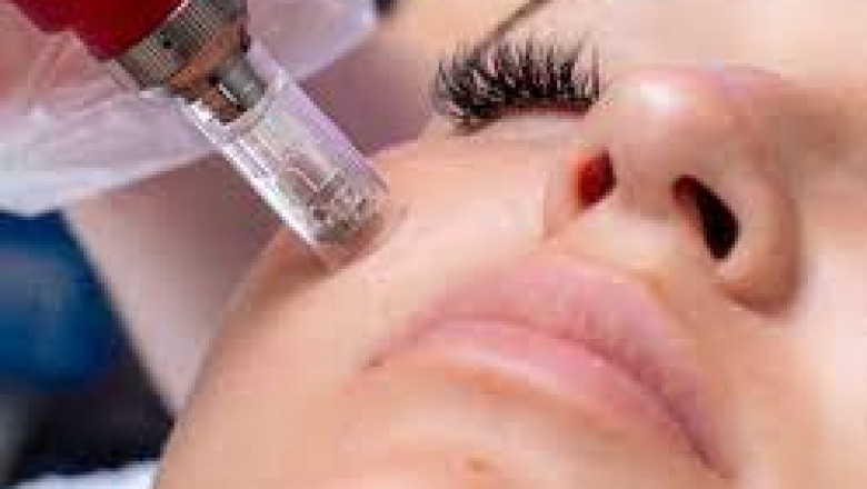 How Soon Will I See Results from a Vampire Facial?