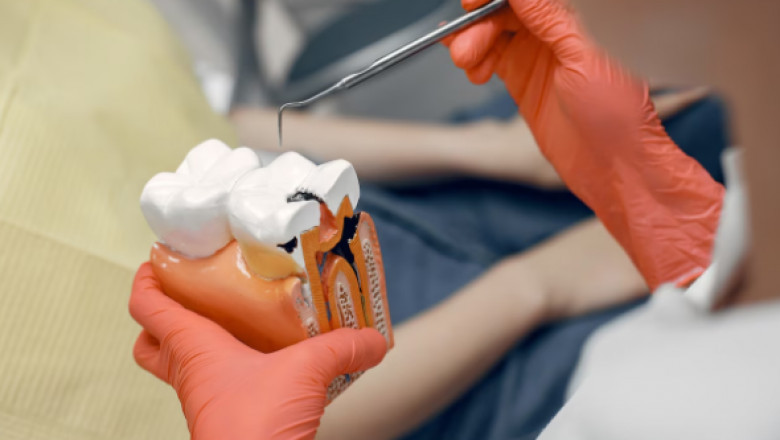 Is a Root Canal Right for You in Keller, TX? Understanding the Procedure and Benefits