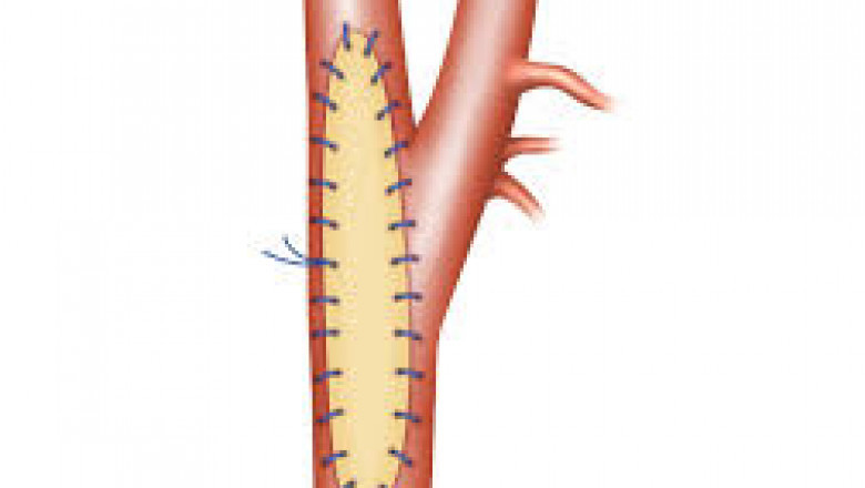 Vascular Patches Market Impacting Factors Include Technological Innovation, Aging Population, and Surgical Advancements