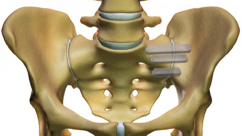 Global Sacroiliac Joint Fusion Market Poised for Growth from Minimally Invasive Techniques