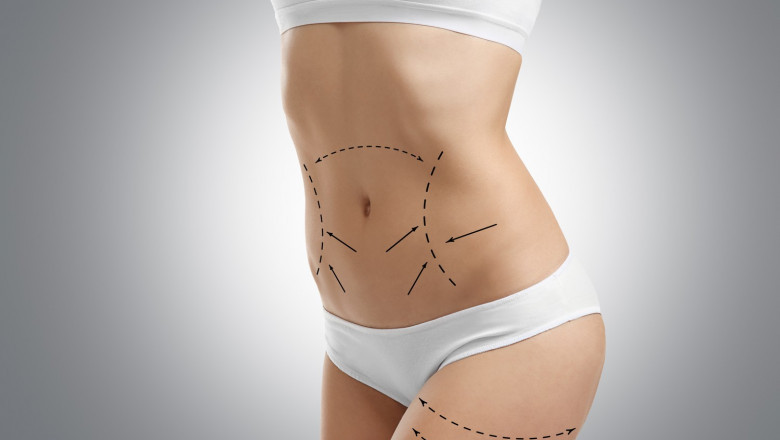Liposuction Surgery: Risks and How to Minimize Them