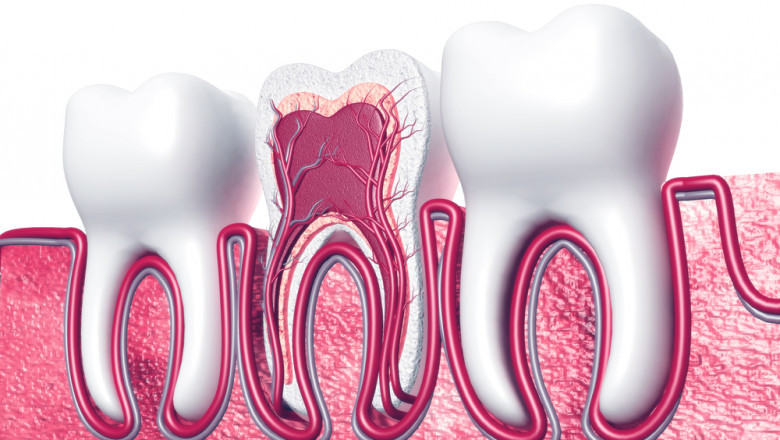 Root Canal vs Herbal Remedies in Islamabad: What Works Better?