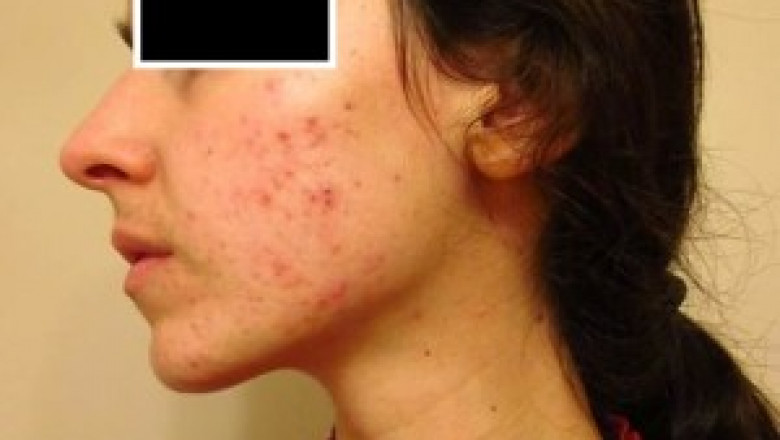 Acne Treatment in Philadelphia at Viva Healthy Life Holistic Center