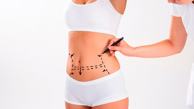 Best Time to Consider Liposuction Surgery