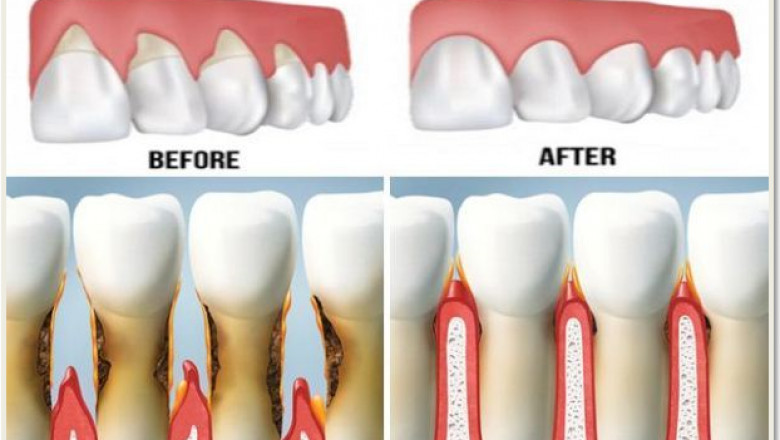 Gingival Recession Market to Soar with Digital Dentistry Advancements