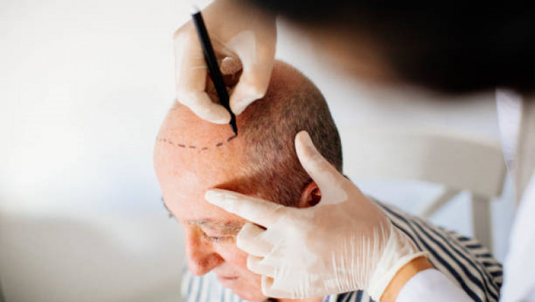 Hair Transplant in Riyadh: Are You a Candidate?