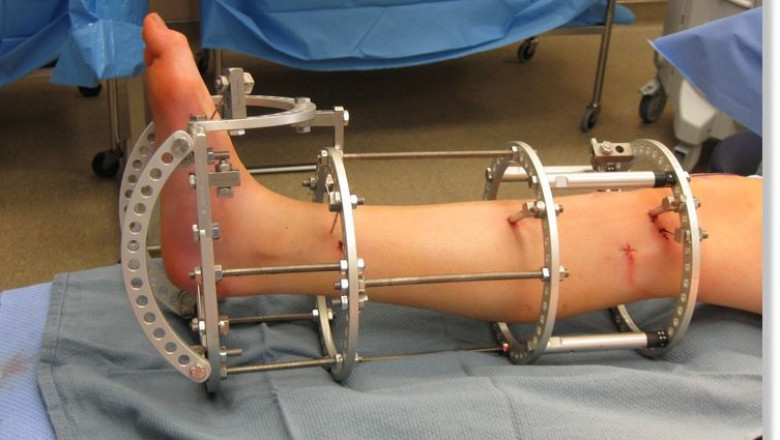 Strategic Outlook on Limb Lengthening Surgery Market Size Growth and End User Applications