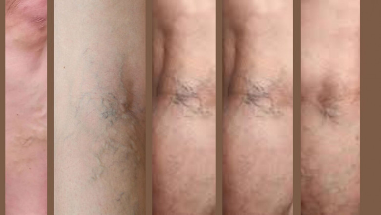 Why Do Varicose Veins Form: Causes and Mechanisms