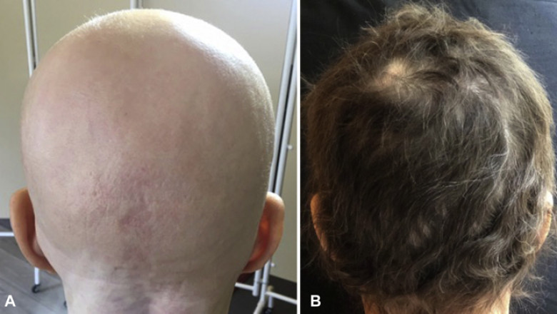 Alopecia Areata Treatment Market Sees High Growth from JAK Inhibitor Therapies