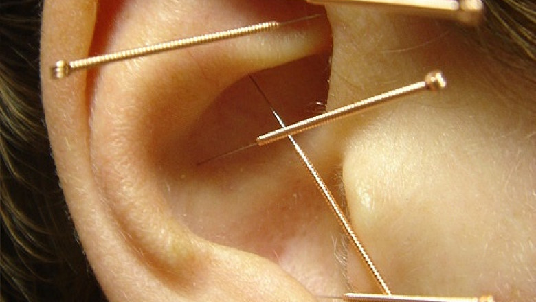 Auricular Therapy – Ear Acupuncture