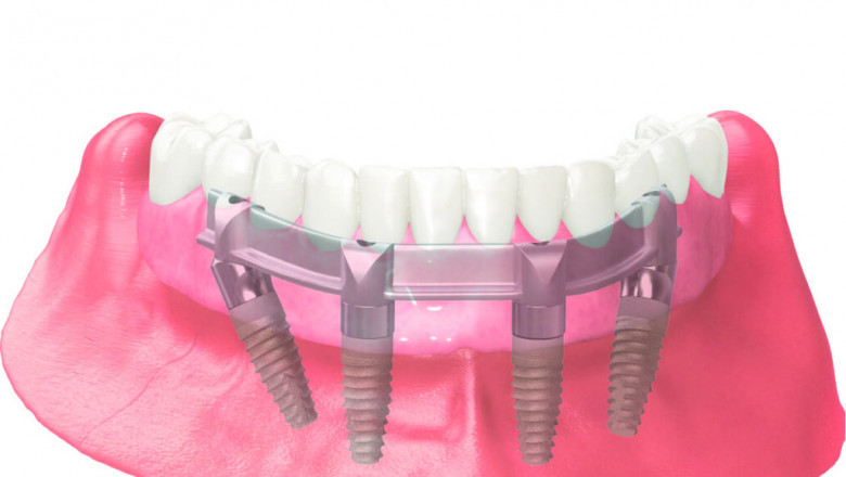 Can You Afford Full Mouth Dental Implants Cost in the Long Run?