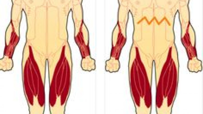 Inclusion Body Myositis Market to Surge with Advanced Immunotherapy Platforms