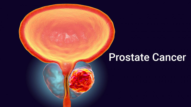Metastatic Prostate Cancer Market is Estimated to Witness High Growth Owing to Next-Gen Precision Oncology Therapies