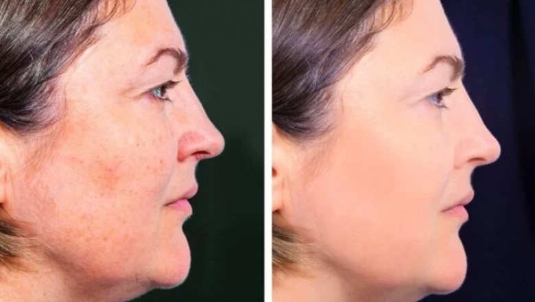 Profhilo Treatments in Dubai: What Happens During and After the Procedures