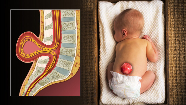 Spina Bifida In-Utero Market is Anticipated to Witness High Growth Owing to Technological Advancements in Prenatal Surgery