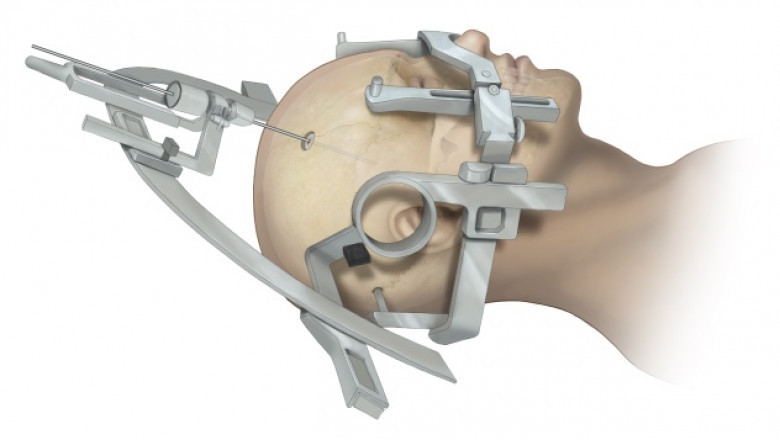 Stereotactic Surgery Devices Market to Grow with Technological Advancements