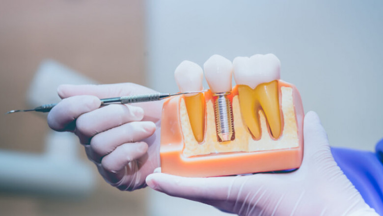 A Chic Look Starts with Dental Implants in Dubai
