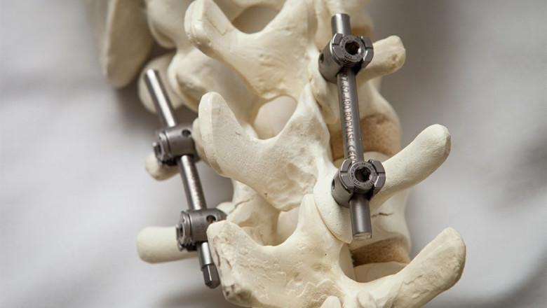 Advancements and Dynamics in Spinal Osteosynthesis Units Market