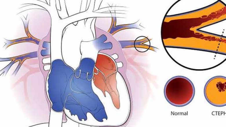 Chronic Thromboembolic Pulmonary Hypertension Market Forecast & Growth