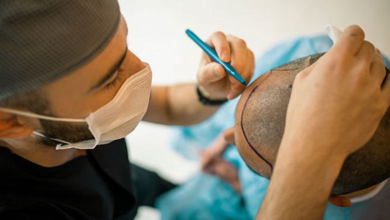 Hair Transplant Turkey – Why It's the Top Choice for Global Patients