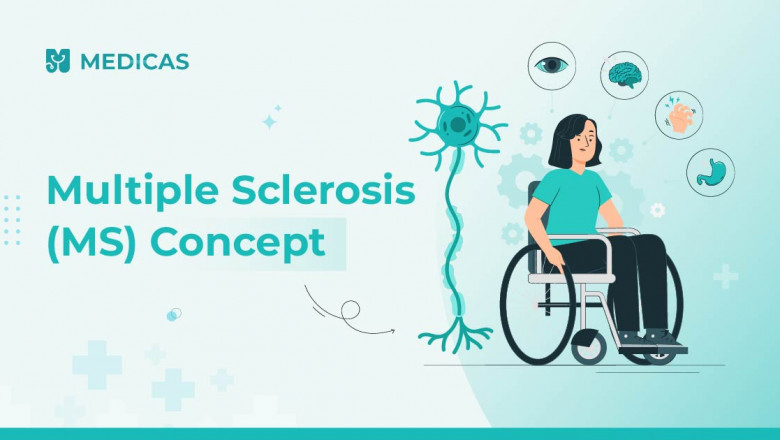 Multiple Sclerosis Explained: Causes, Symptoms & Best Treatment Plans in India