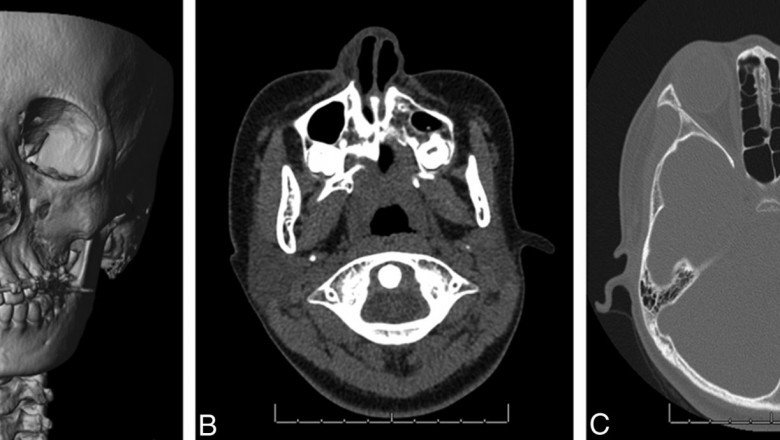 Parry Romberg Syndrome Market Growth and Strategic Outlook