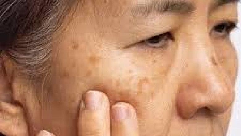 Protecting Your Skin from Sun-Induced Melasma