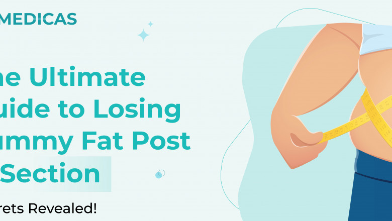 Safe and Proven Tips to Lose Postpartum Weight After Cesarean