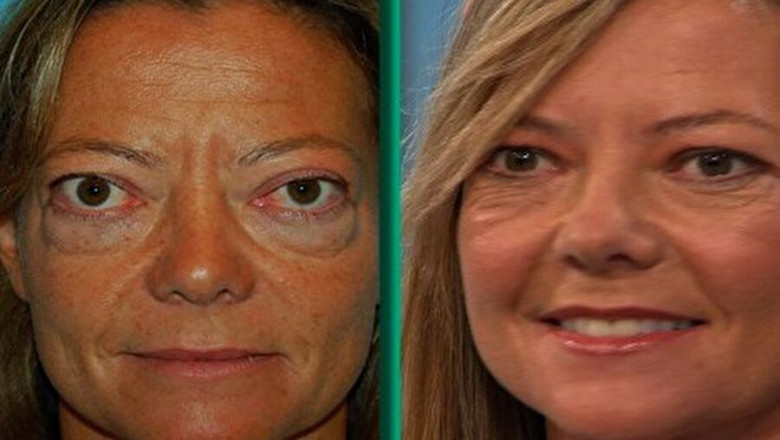 Thyroid Eye Disease (TED) Market Set to Surge Owing to Targeted Biologics
