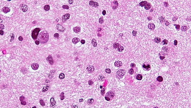 Astrocytoma Drug Market Size Forecast and Trends