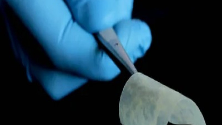 Exploring Autologous Matrix-induced Chondrogenesis: A Promising Approach for Cartilage Repair