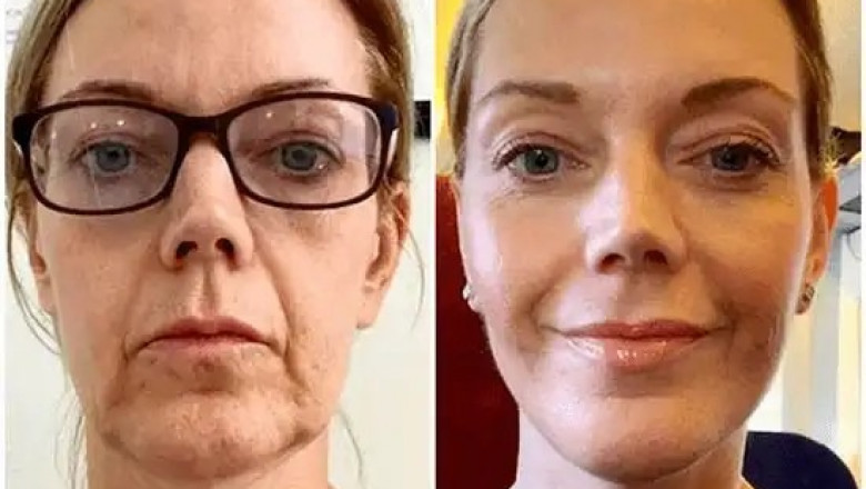 Refresh Complexion with Profhilo by Best Doctors in dubai
