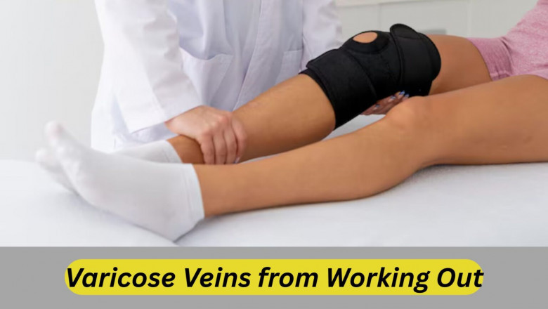 Varicose Veins from Working out: Myths, Facts, and Prevention