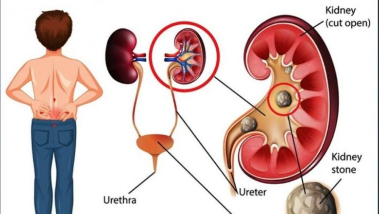 Benefits of Retrograde Intrarenal Surgery in Dehradun A Minimally Invasive Approach