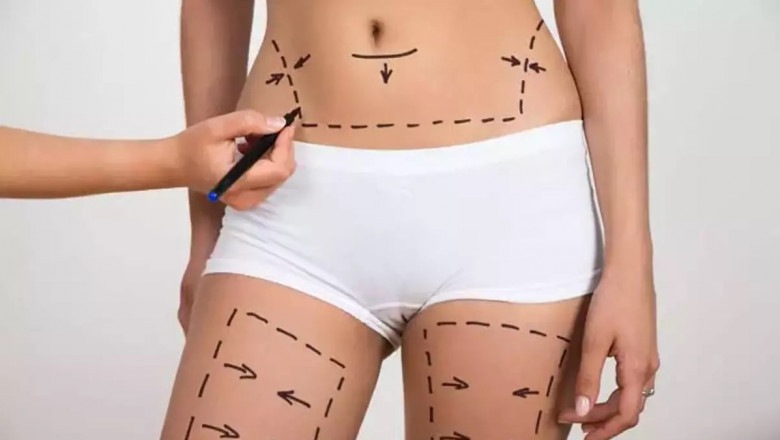 How to Choose the Best Clinic for Liposuction Surgery