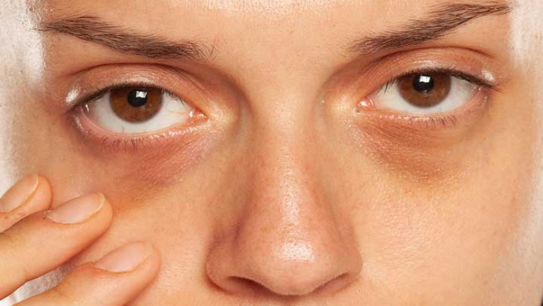 Dark Circle Treatment: Vitamin K Benefits