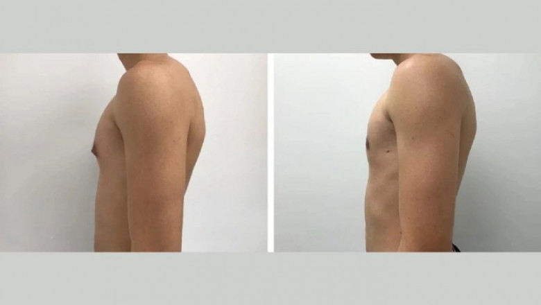 Who Is the Ideal Candidate for Gynecomastia Surgery in Dubai?