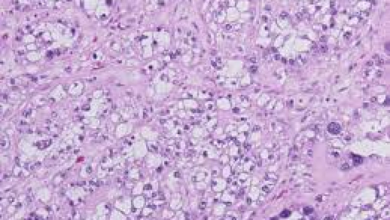 Clear Cell Ovarian Cancer Market Growth Trends Analysis
