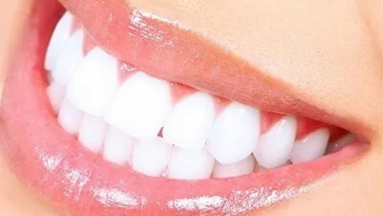 Can Veneers Replace the Need for Whitening?